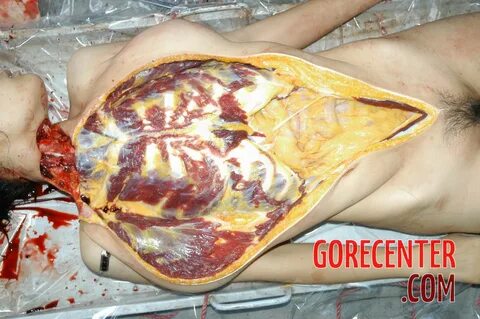 Autopsy of Chinese woman #2.