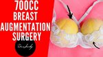 700cc Breast augmentation 162 lbs San Antonio Austin breast 