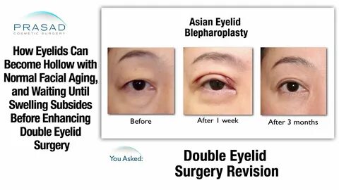 How Asian Eyelid Surgery Can be Affected by Aging, and the R