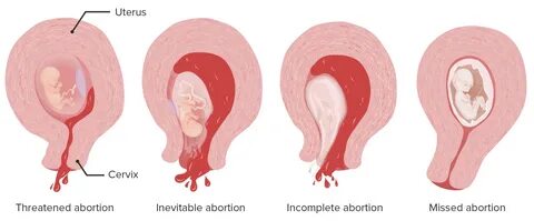 Spontaneous Abortion Concise Medical Knowledge