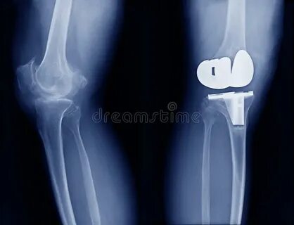 The Knee Replacement Surgery Lesions Stock Photo - Image of 