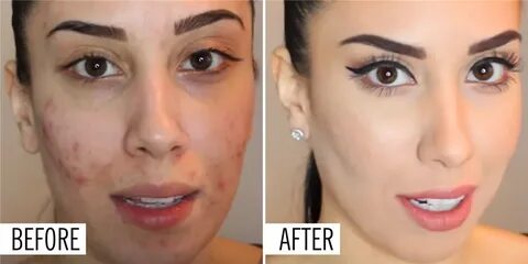 The 17 Best Foundations That Actually *Help* Your Acne Found