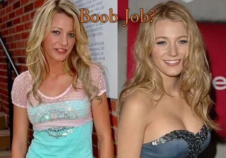Blake Lively Plastic Surgery Before & After - TopCelebritySu