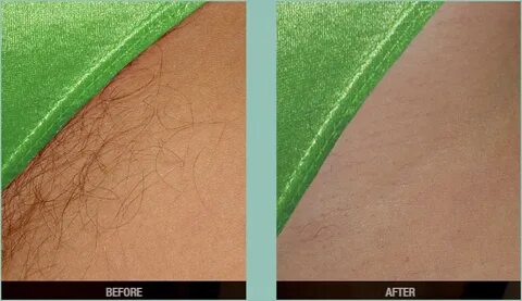 Bikini Brazilian Laser Hair Removal - Kallista Laser Hair Re