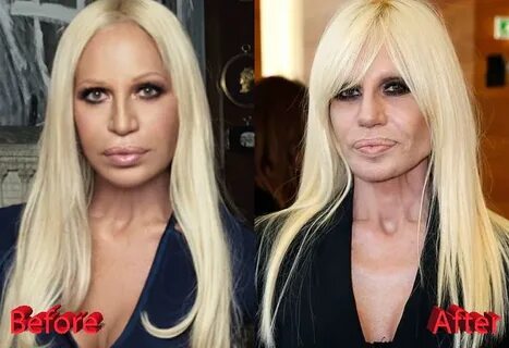 Donatella Versace Before and After Plastic Surgery - Plastic