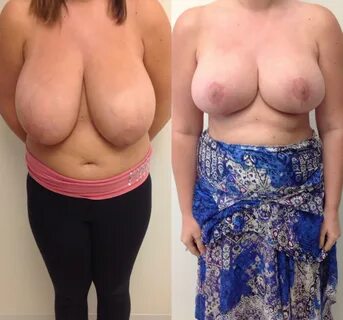 Before and after boob reduction