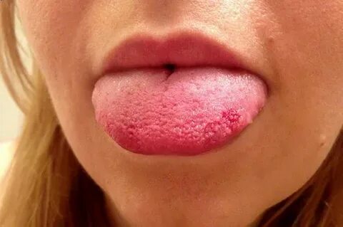 Swollen Taste Buds Causes on Tongue, Back, Side, Tip of Tong