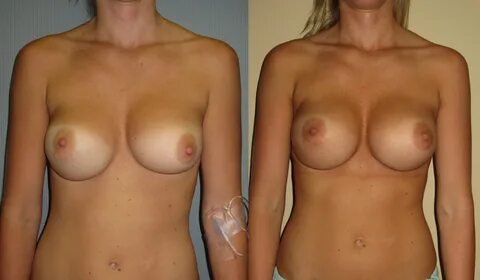 Nude breast implants.