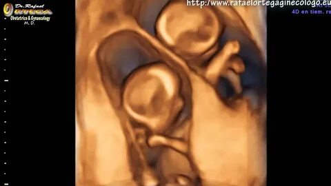 4D ultrasound 12 weeks pregnant twins jumping Rafael Ortega 