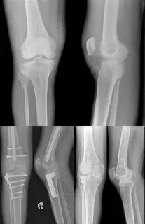 Tibial Plateau Fractures - Radiology Notes