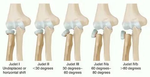 Radial Head and Neck Fractures - Pediatric - Pediatrics - Or