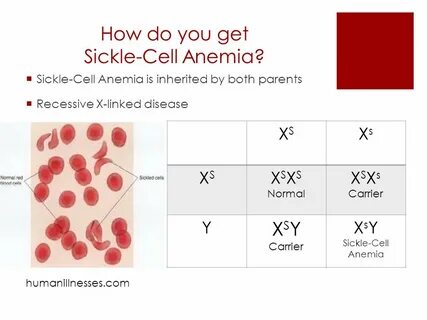 Sickle-Cell Anemia By Kenley, Sam, Shannon aurorahealthcare.