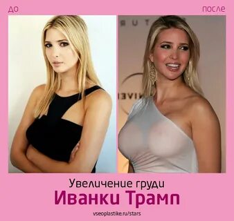 Иванка Трамп до и после увеличения груди Все О пластике Янде