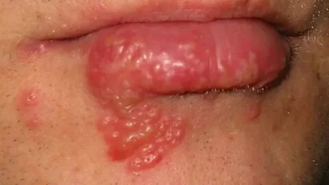 Pickel An Der Lippe : Hilfe Pickel Oder Herpes Gesundheit Be