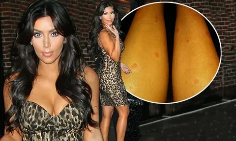 How Kim Kardashian covers up her psoriasis spots... the befo