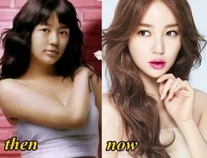 Yoon Eun Hye Plastic Surgery Before and After - Plastic Surg