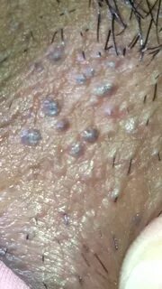 Ingrown Hair On Testicle Sack - Bumps on Scrotum lia19-jm5b