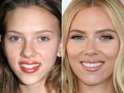 Scarlett Johansson Plastic Surgery - Before and After Photos