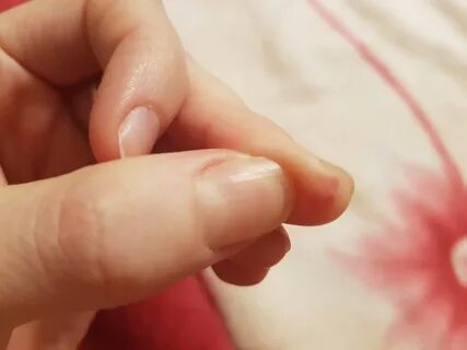 Болит кончик пальца на левой руке - Вопрос дерматологу - 03 