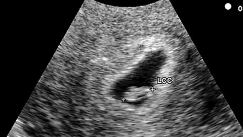 abdominal ultrasound at 7 weeks - Pregnancy Informations
