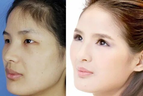 Китаянки до и после пластики : / фото 16 Plastic surgery, Co