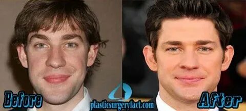 John Krasinski Rhinoplasty Surgery Nose job, Plastic surgery