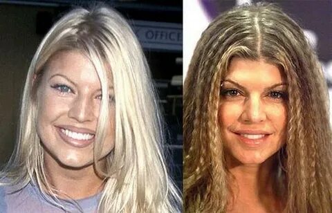 Fergie Plastic Surgery