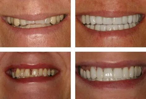 Antes y después de carillas dentales instalada Carillas dent