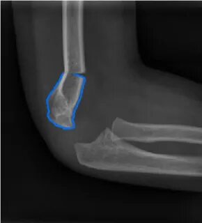 Supracondylar fracture Gartland 3. Download Scientific Diagr