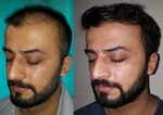 FUE Hair transplant Surgery at Boston Aesthetics Lahore Bost