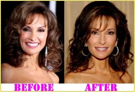 Susan Lucci Plastic Surgery