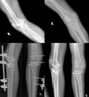 What is the classification system of tibial plateau fracture