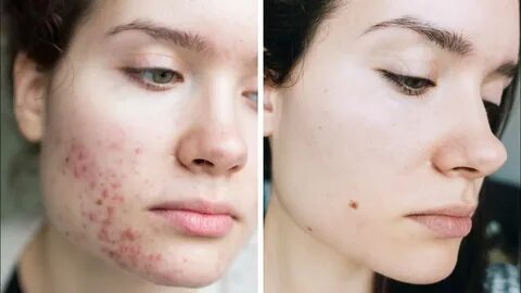 Acne Skincare + Overnight Tips & Tricks How To Stop Picking 