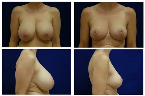 Breast Reduction Case 751 - The Plastic Surgery Group.