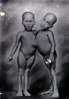 File:A pair of young, female, conjoined twins. Photograph. W