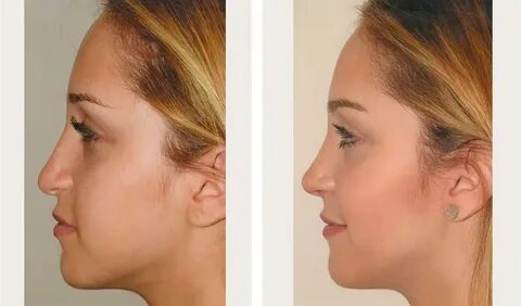 How To Get A Free Nose Job In Canada " New Ideas