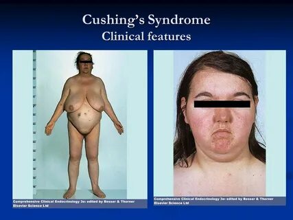 Cushing’s Syndrome A Clinical Approach - ppt download