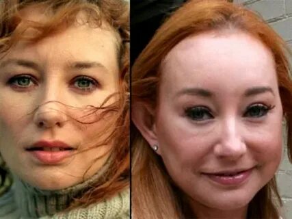 Tori Amos Plastic Surgery Before and After - Celeb Surgery