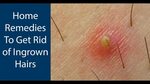 How To Get Rid of Ingrown Hairs Natural Home Remedies - YouT