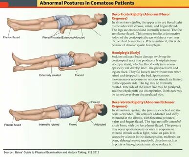 Manual Of Medicine on Twitter: "Abnormal Postures in Comatos