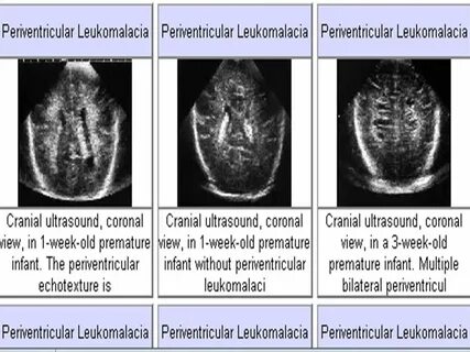 Infection and white matter damage - ppt video online downloa