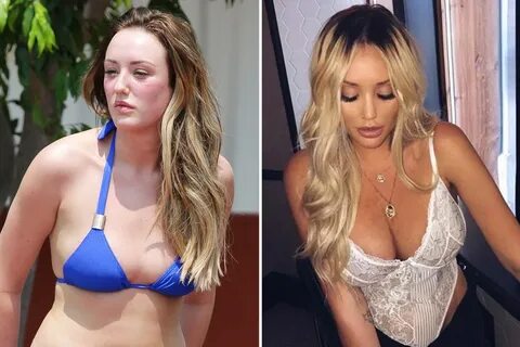 How 'unlucky' Charlotte Crosby was left with a 'uniboob' tha