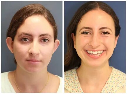 NYC Otoplasty Cosmetic Ear Surgery Before and After Pictures