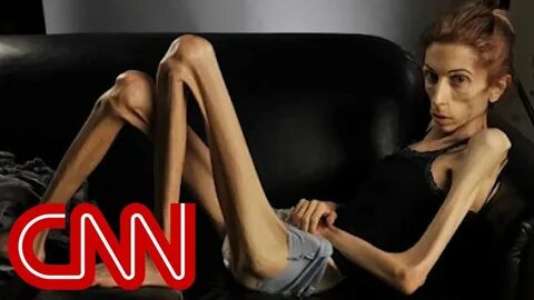 Anorexic woman's dramatic transformation - YouTube