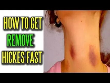 How To Get Rid Of Hickies Fast How to Get Rid of Hickeys Fas