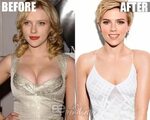 Scarlett Johansson Plastic surgery: Breast Reduction Before 
