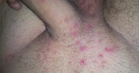 Ingrown Hair On Penis Shaft - Black Ass