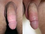 Circumcised Vs. Autocircumcised - Autocircumcision