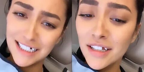 Pretty Little Liars' star Shay Mitchell says she lost tooth 