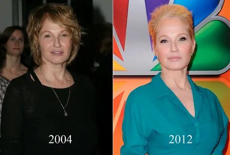 Ellen Barkin Plastic Surgery